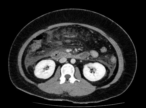 Acute pancreatitis (Radiopaedia 69236-79012 Axial C+ portal venous phase 43).jpg