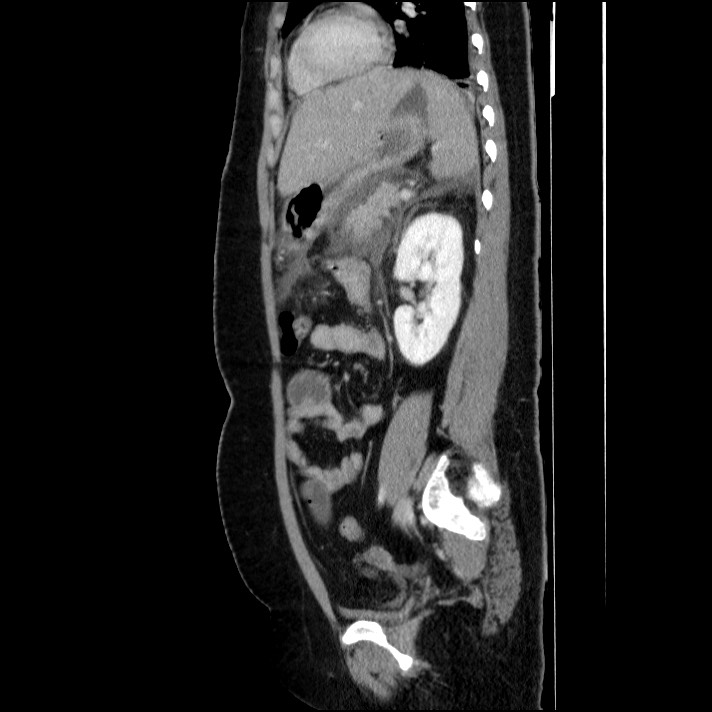 Acute pancreatitis (Radiopaedia 69236-79012 Sagittal C+ portal venous phase 40).jpg