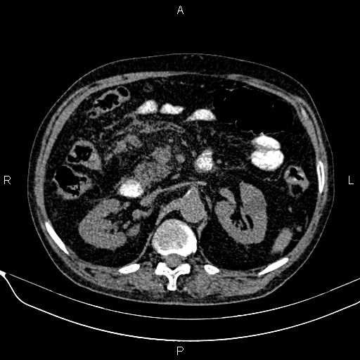 Acute pancreatitis (Radiopaedia 85146-100701 Axial non-contrast 49).jpg