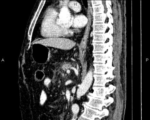 Acute pancreatitis (Radiopaedia 85146-100701 Sagittal C+ portal venous phase 50).jpg