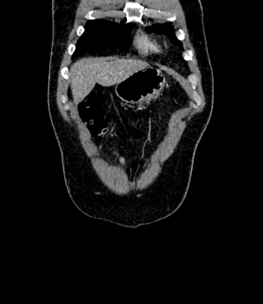 Acute pancreatitis (Radiopaedia 87428-103757 Coronal C+ portal venous phase 11).jpg