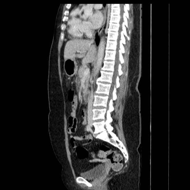 Acute pancreatitis - Balthazar C (Radiopaedia 26569-26714 Sagittal C+ portal venous phase 34).jpg