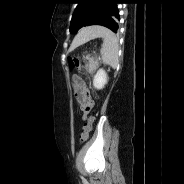 Acute pancreatitis - Balthazar C (Radiopaedia 26569-26714 Sagittal C+ portal venous phase 53).jpg