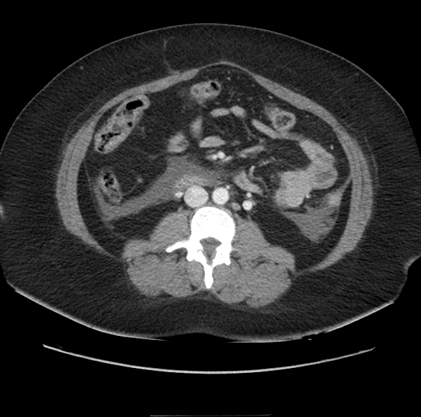 Acute pancreatitis - Balthazar E (Radiopaedia 29016-29377 Axial C+ portal venous phase 37).png