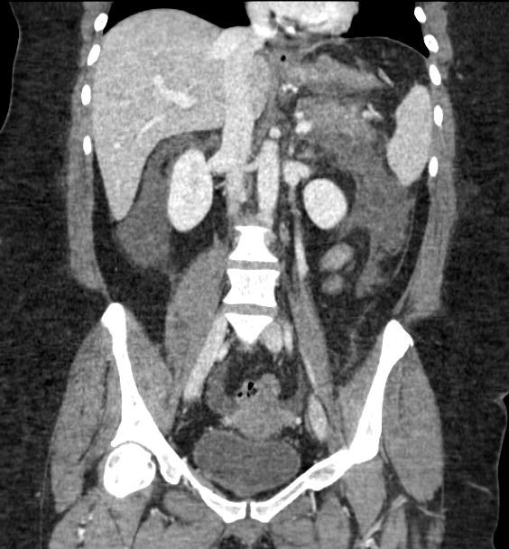 Acute pancreatitis - Balthazar E (Radiopaedia 29016-29377 Coronal C+ portal venous phase 53).png