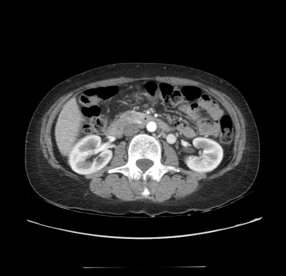 File:Acute pancreatitis - Balthazar E - post ERCP (Radiopaedia 27562-27772 Axial C+ arterial phase 27).png
