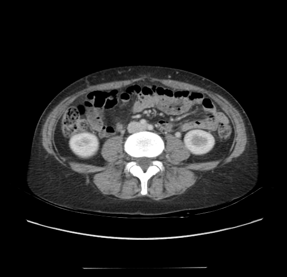 Acute pancreatitis - Balthazar E - post ERCP (Radiopaedia 27562-27772 Axial C+ portal venous phase 44).png