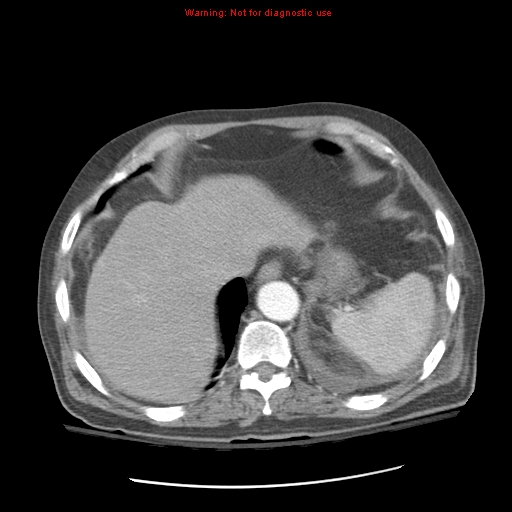 Acute pancreatitis with incidental pancreatic lipoma (Radiopaedia 10190-10730 Axial C+ arterial phase 17).jpg