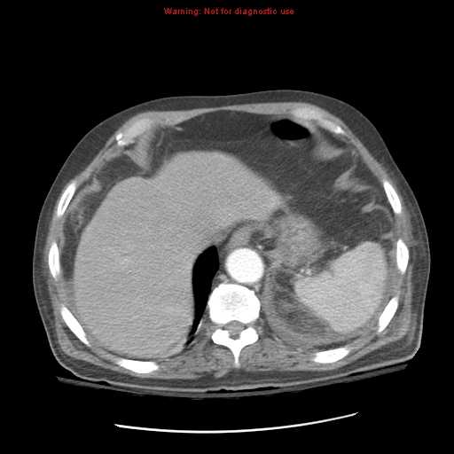 Acute pancreatitis with incidental pancreatic lipoma (Radiopaedia 10190-10730 Axial C+ arterial phase 18).jpg