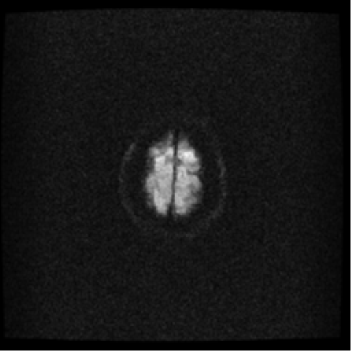 File:Acute pontine infarct from vertebral artery dissection (Radiopaedia 34111-35370 Axial DWI 22).png