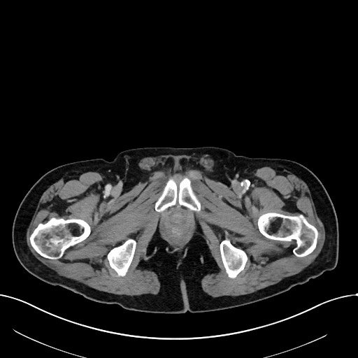 Acute renal infarction (Radiopaedia 59375-66736 Axial C+ portal venous phase 125).jpg