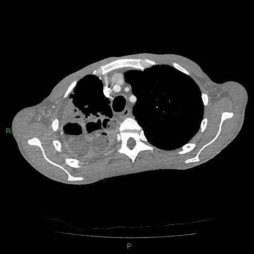 File:Acute right lung abscess (Radiopaedia 34806-36258 Axial C+ arterial phase 41).jpg