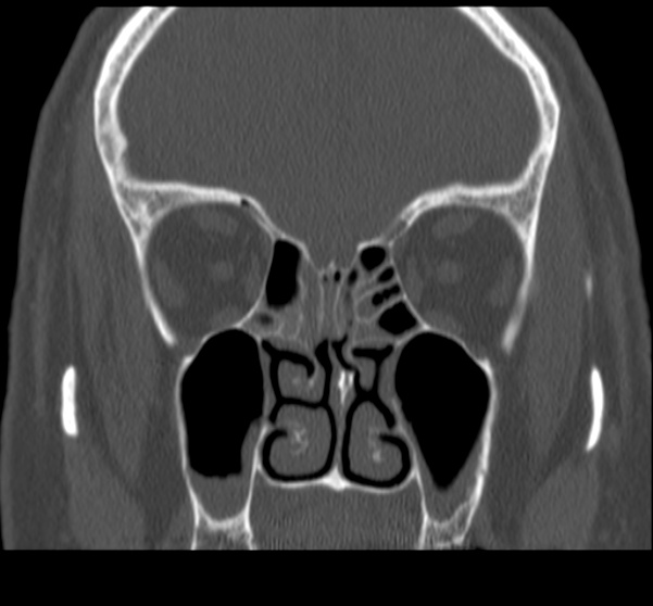 File:Acute sinusitis (Radiopaedia 23161-23215 Coronal bone window 37).jpg