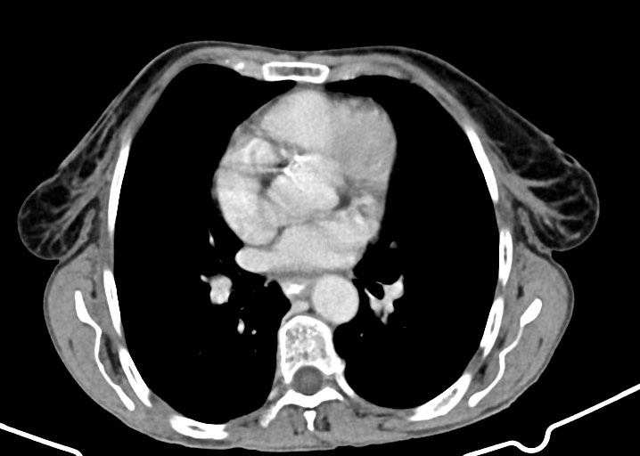 Acute small bowel (ileal) volvulus (Radiopaedia 71740-82139 Axial C+ portal venous phase 16).jpg