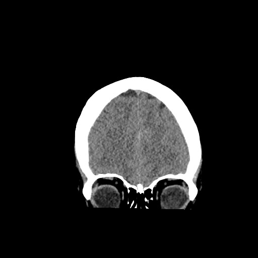Acute subarachnoid hemorrhage and accessory anterior cerebral artery (Radiopaedia 69231-79008 Coronal non-contrast 18).jpg