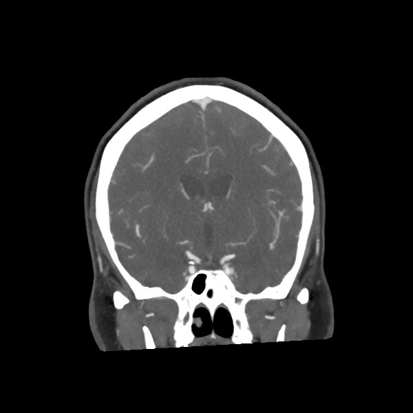 Acute subarachnoid hemorrhage and accessory anterior cerebral artery (Radiopaedia 69231-79009 Coronal C+ arterial phase 38).jpg