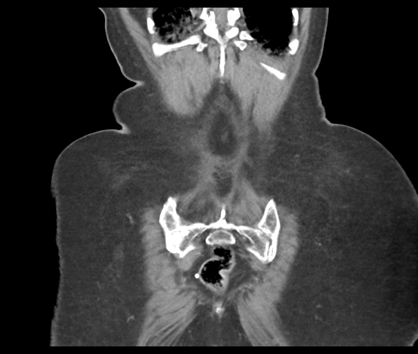 File:Acute superior mesenteric artery occlusion (Radiopaedia 43926-47418 Coronal C+ portal venous phase 46).png