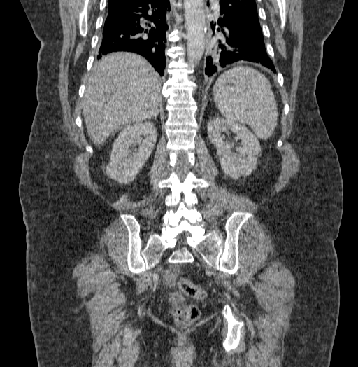 Acute superior mesenteric artery occlusion (Radiopaedia 51288-56960 Coronal C+ portal venous phase 56).jpg
