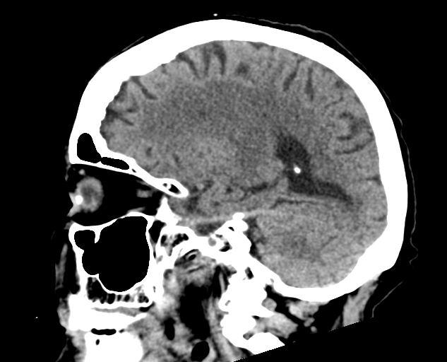 Acute traumatic subdural hematoma (Radiopaedia 82921-97257 Sagittal non-contrast 29).jpg