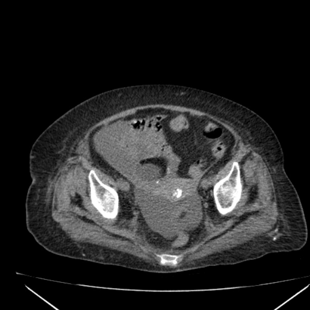 Acute tubular necrosis (Radiopaedia 28077-28334 Axial non-contrast 59).jpg