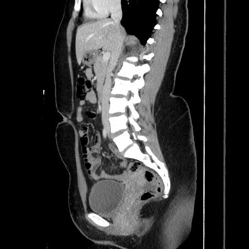 Acute uncomplicated appendicitis (Radiopaedia 73704-84499 Sagittal C+ portal venous phase 106).jpg