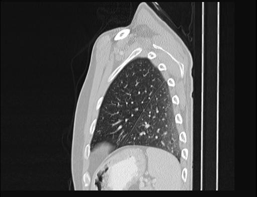 Addison disease (Radiopaedia 49318-54412 Sagittal lung window 11).jpg