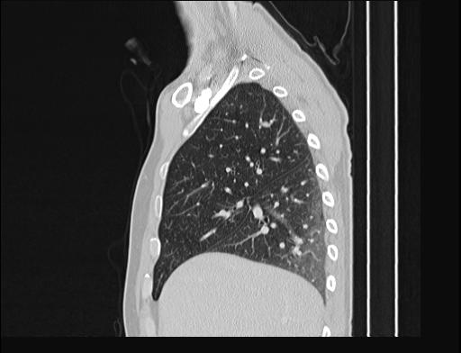 File:Addison disease (Radiopaedia 49318-54412 Sagittal lung window 46).jpg