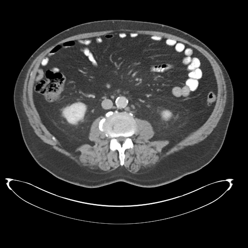 File:Adenocarcioma of rectum- T1 lesion (Radiopaedia 36921-38547 Axial C+ portal venous phase 45).png