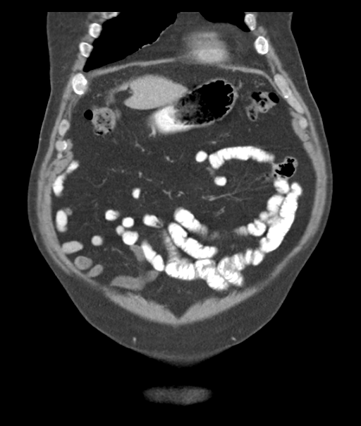Adenocarcioma of rectum- T1 lesion (Radiopaedia 36921-38547 Coronal C+ portal venous phase 15).png