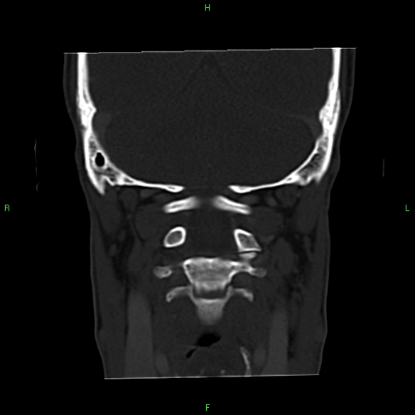 File:Adenoid cystic carcinoma of hard palate (Radiopaedia 26137-26273 Coronal bone window 30).jpg