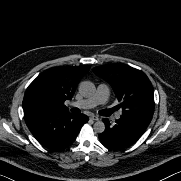 Adenoid cystic carcinoma of the trachea (Radiopaedia 49042-54137 Axial non-contrast 154).jpg