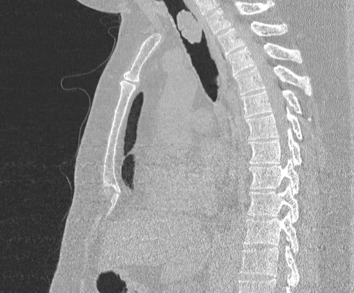 Adenoid cystic carcinoma of the trachea (Radiopaedia 49042-54137 Sagittal lung window 240).jpg