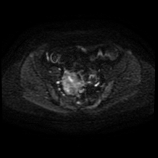 File:Adenoma malignum of cervix (Radiopaedia 66441-75705 Axial DWI 56).jpg