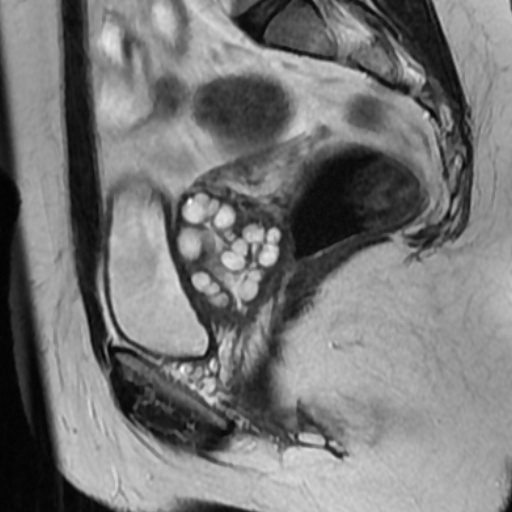 File:Adenoma malignum of cervix (Radiopaedia 66441-75705 Sagittal T2 14).jpg