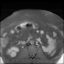 File:Adenomyosis within a didelphys uterus (Radiopaedia 70175-80215 Axial T1 C+ fat sat 1).jpg