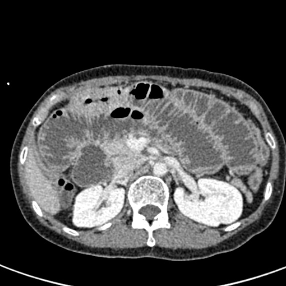 File:Adhesional small bowel obstruction (Radiopaedia 48397-53305 Axial C+ portal venous phase 24).jpg