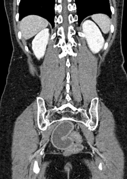 Adhesional small bowel obstruction (Radiopaedia 48397-53305 Coronal C+ portal venous phase 281).jpg