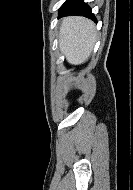 Adhesional small bowel obstruction (Radiopaedia 58900-66131 Sagittal C+ portal venous phase 25).jpg