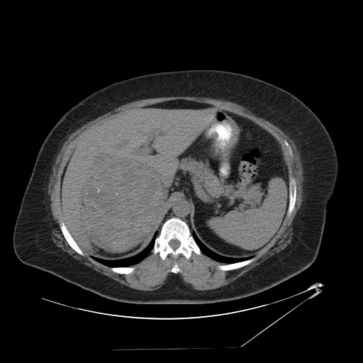 Adrenal angiosarcoma (Radiopaedia 81081-94671 Axial non-contrast 20).jpg