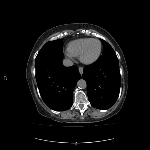 File:Adrenal collision tumor (ACT) (Radiopaedia 48462-53379 Axial non-contrast 2).jpg