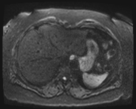 Adrenal cortical carcinoma (Radiopaedia 64017-72770 Axial DWI 46).jpg