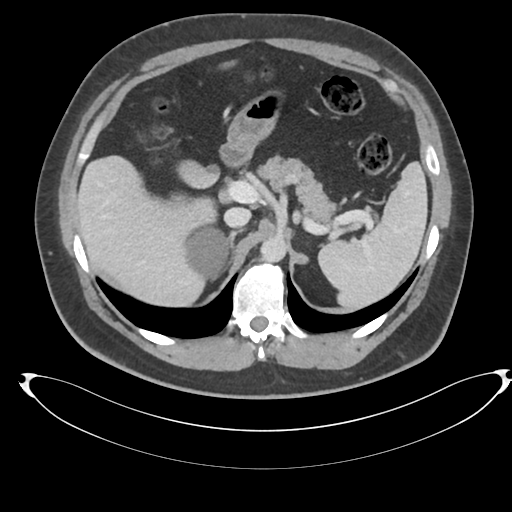File:Adrenal cyst (Radiopaedia 45625-49778 AXIAL THICK 60 sec 16).png