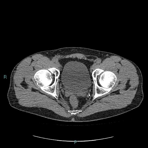 Adrenal cystic lymphangioma (Radiopaedia 83161-97534 Axial non-contrast 93).jpg