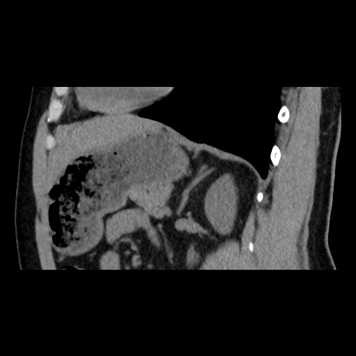 File:Adrenal gland trauma (Radiopaedia 81351-95079 Sagittal non-contrast 65).jpg