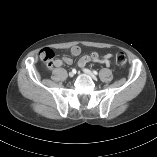 File:Adrenal hematoma (Radiopaedia 44334-47968 Axial C+ portal venous phase 58).png