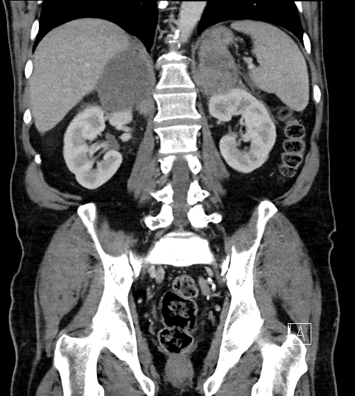 Adrenal lymphoma (Radiopaedia 73730-84529 Coronal C+ portal venous phase 54).jpg