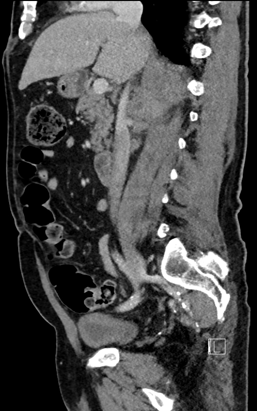 Adrenal lymphoma (Radiopaedia 73730-84529 Sagittal C+ portal venous phase 49).jpg