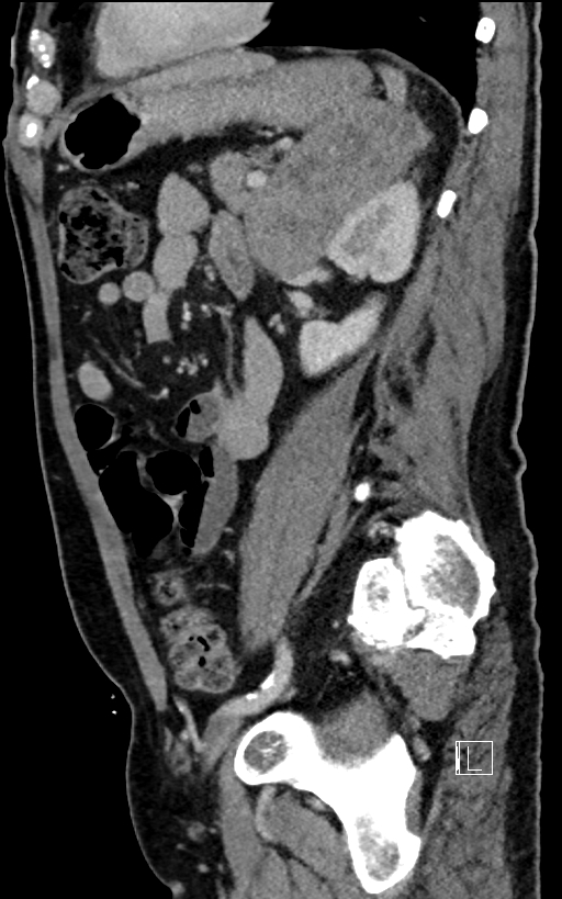 Adrenal lymphoma (Radiopaedia 73730-84529 Sagittal C+ portal venous phase 75).jpg