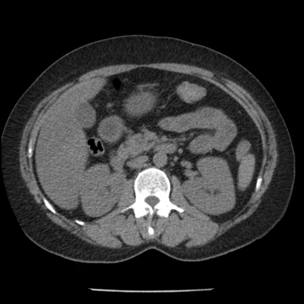 Adrenal myelolipoma (Radiopaedia 43401-46759 Axial non-contrast 35).jpg