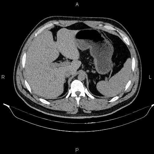 Adrenal myelolipoma (Radiopaedia 84321-99619 Axial non-contrast 27).jpg